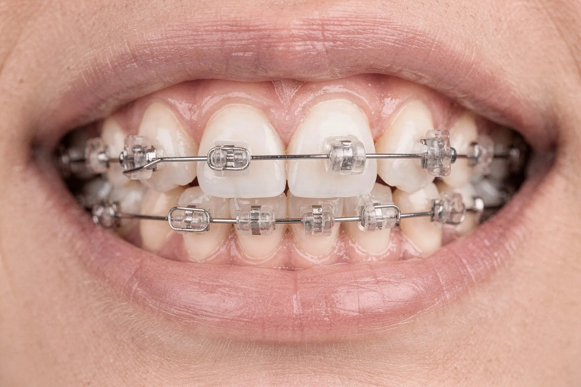 Close-up of teeth with modern aesthetic ceramic braces