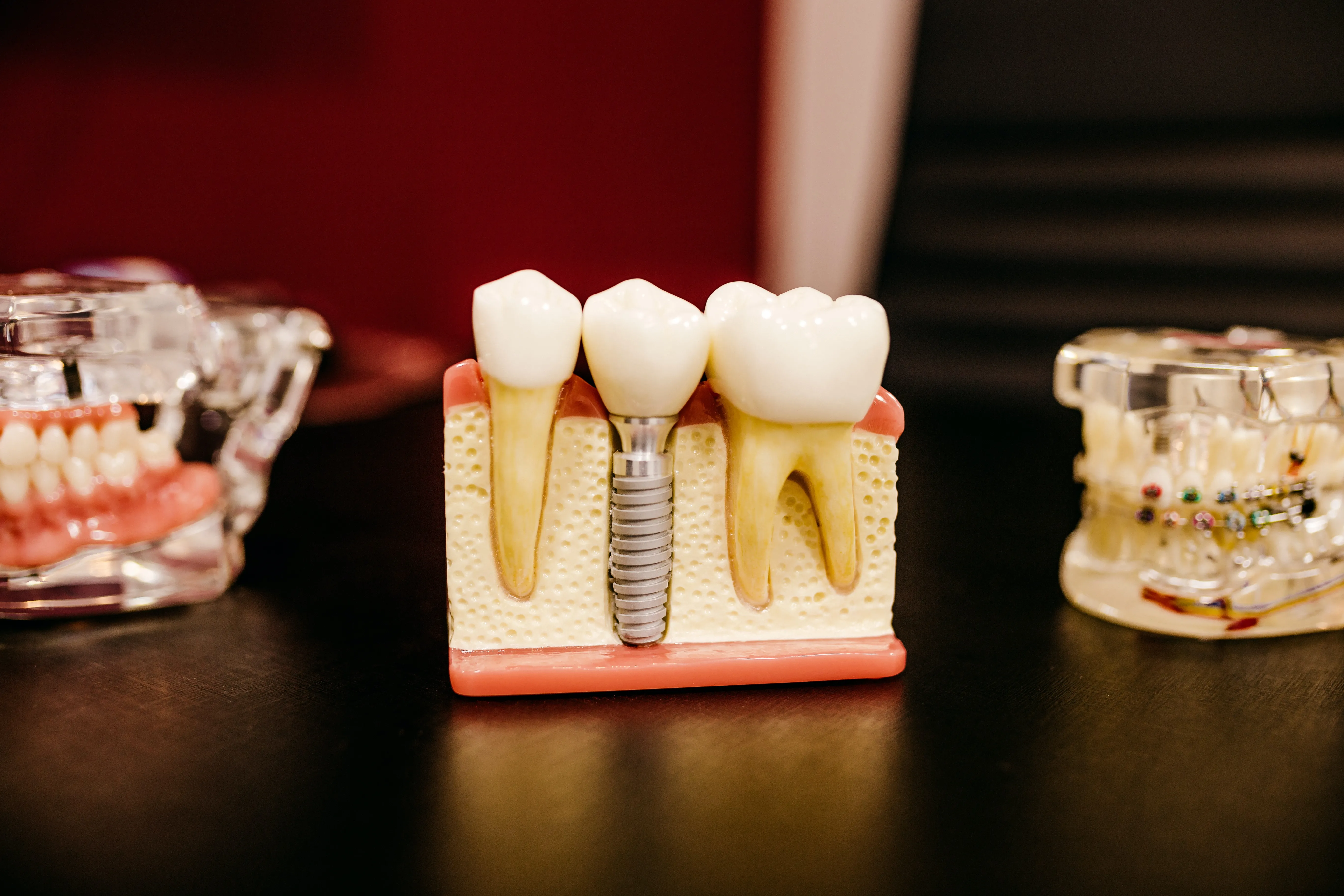 Cutaway model showing a dental implant set in the jaw
