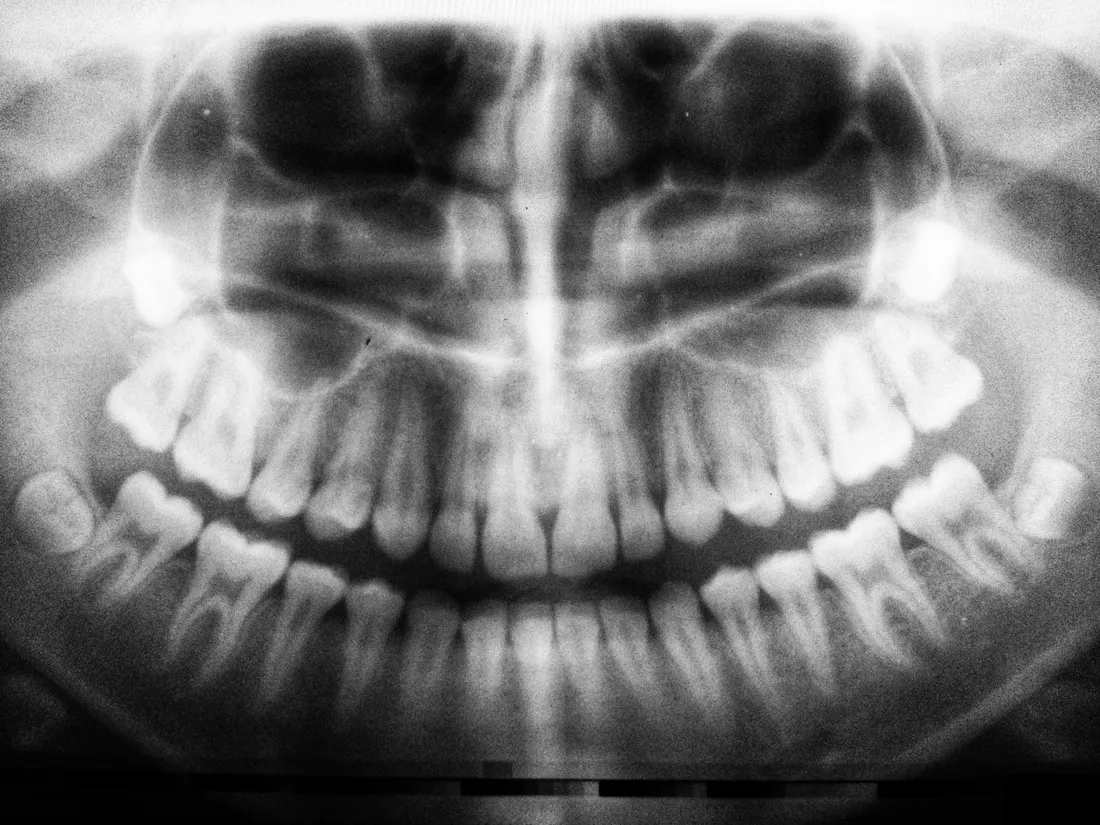 A panoramic dental X-ray on a digital imaging screen