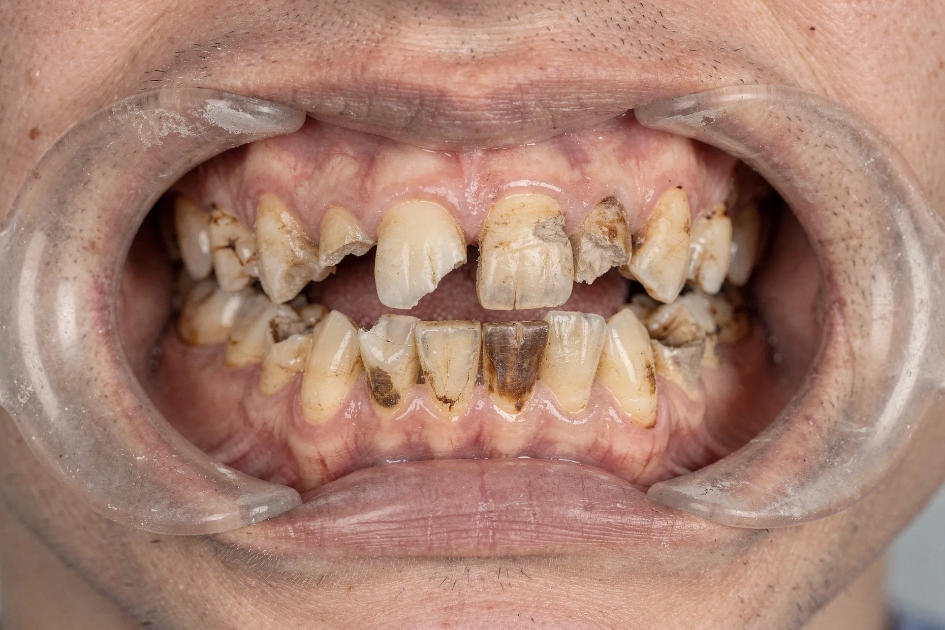 Simulation: heavily worn and damaged teeth before full-mouth restoration