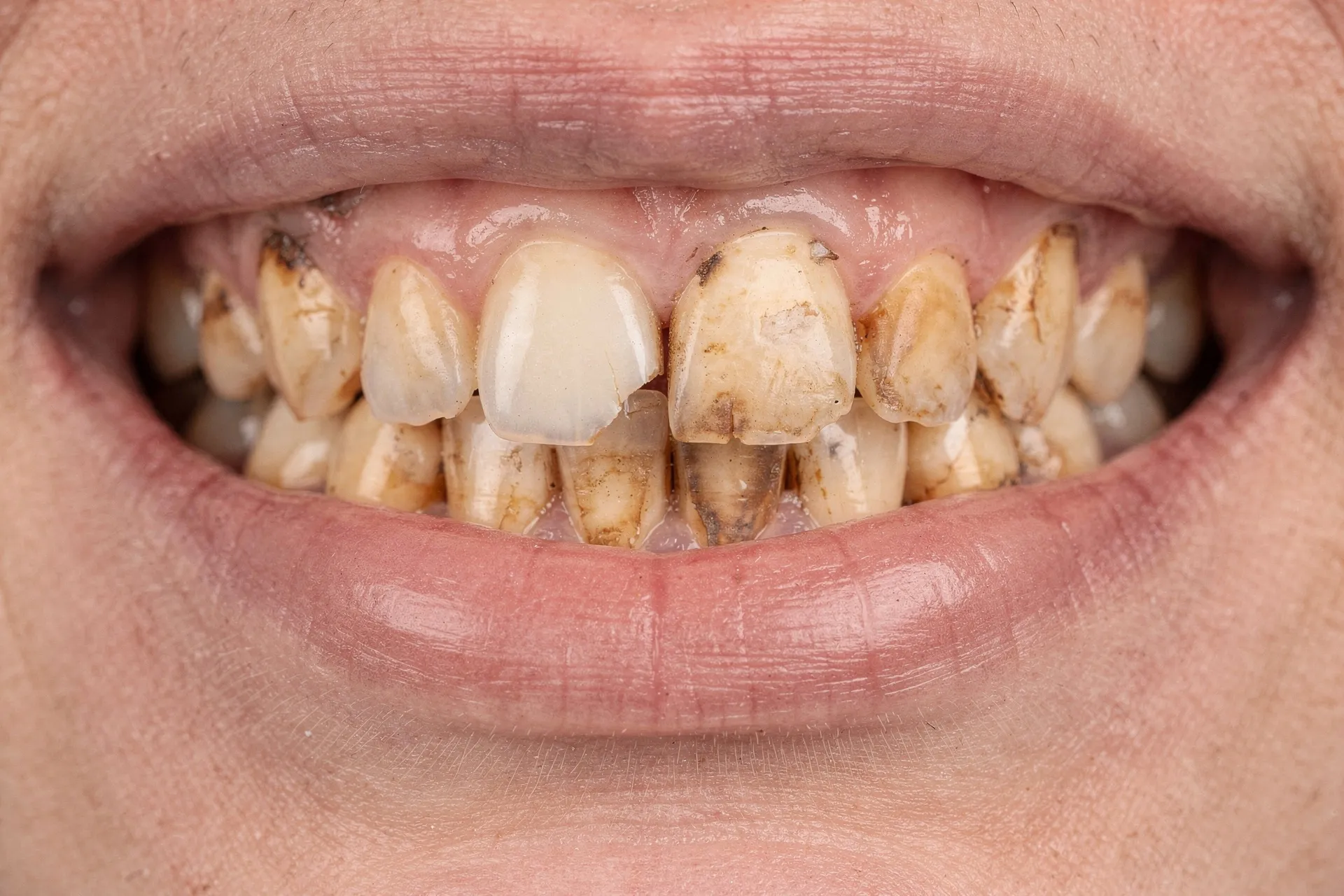 Simulation: stained and chipped front teeth before a smile makeover
