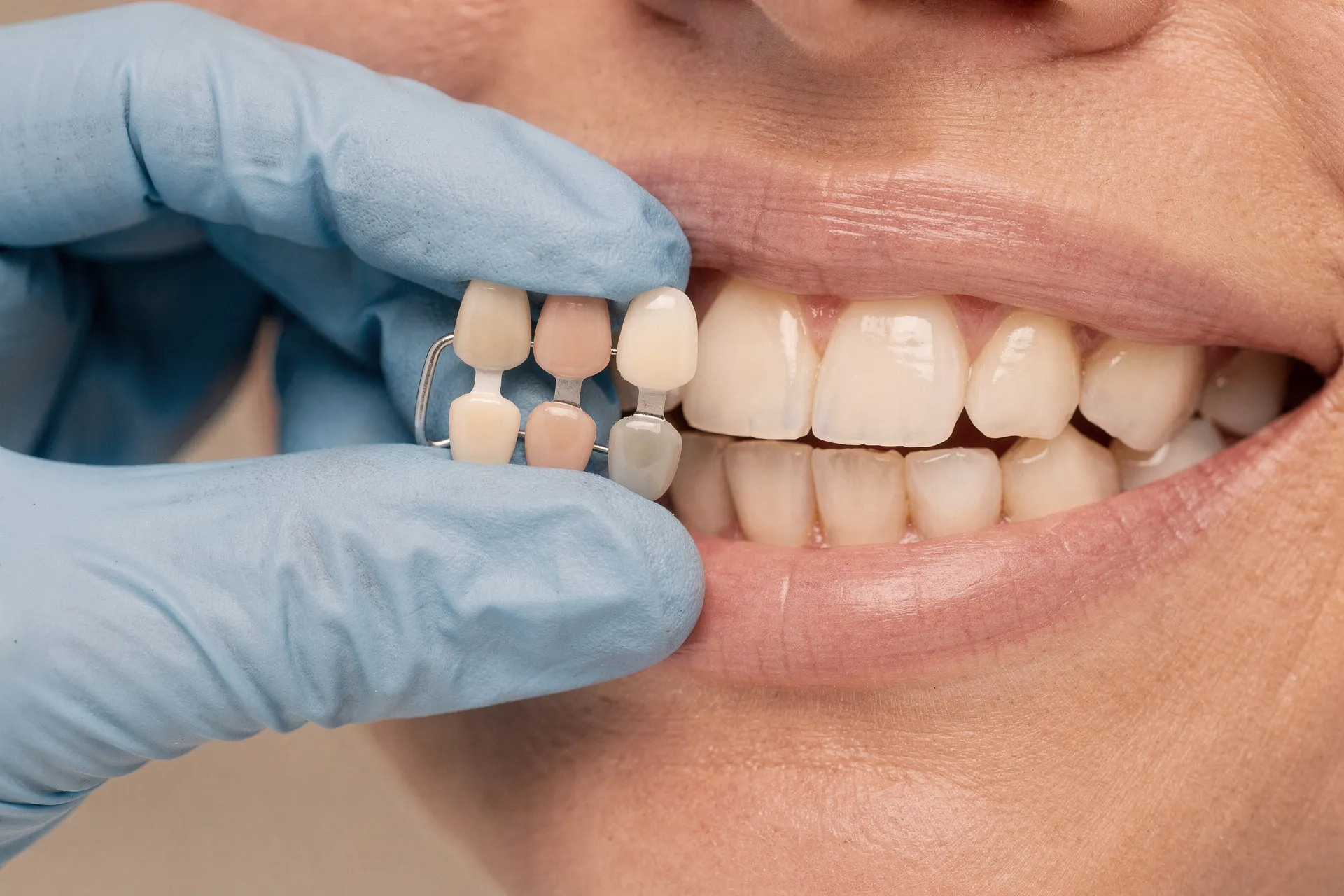 Dentist matching tooth color with a porcelain shade guide