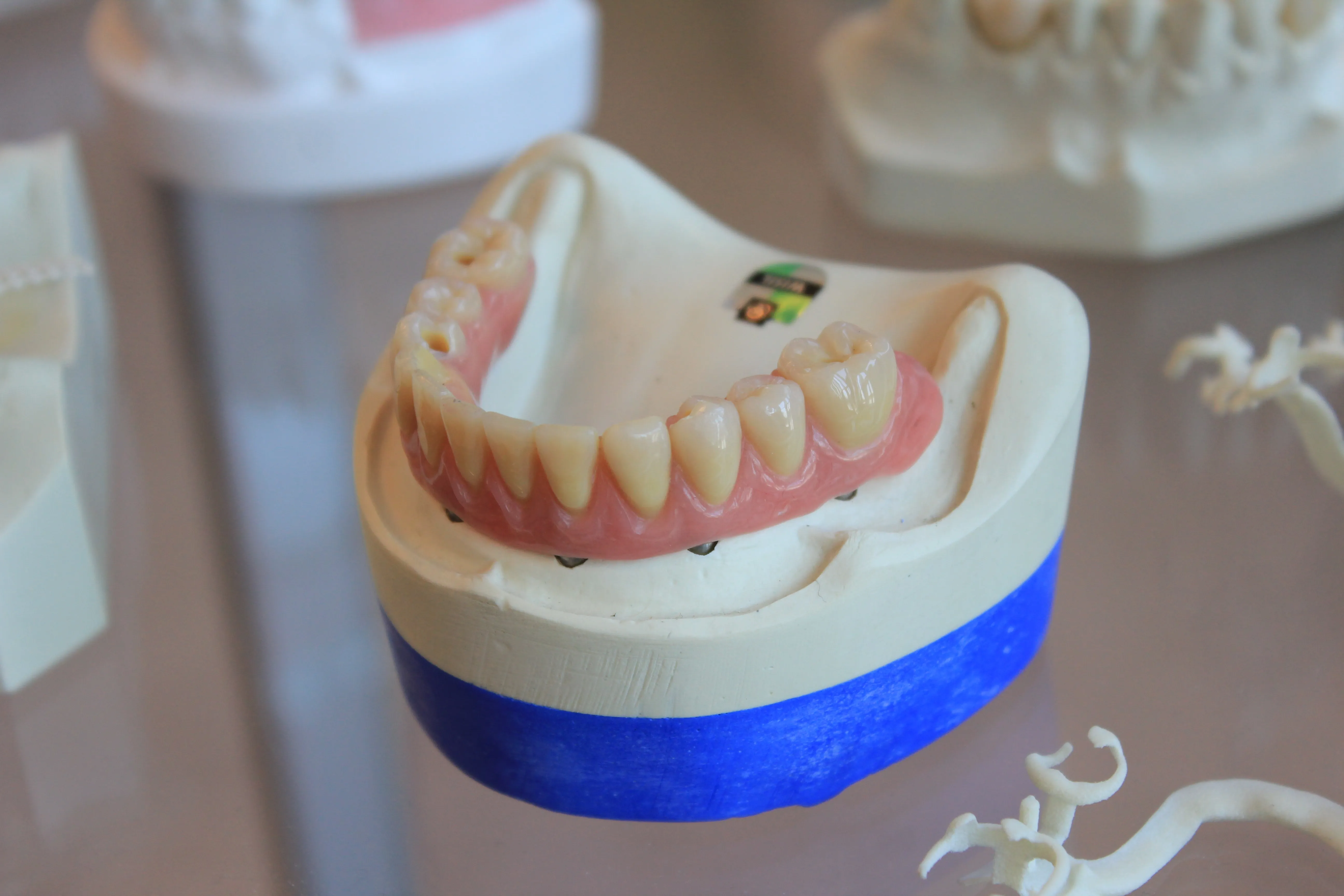 A custom dental prosthetic crafted in our in-house laboratory